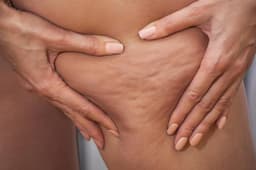 What causes unwanted clusters of cellulite to show through the skin? Is there any way to get rid of unwanted fat once and for all? Learn more today with Cosmetic Clinic