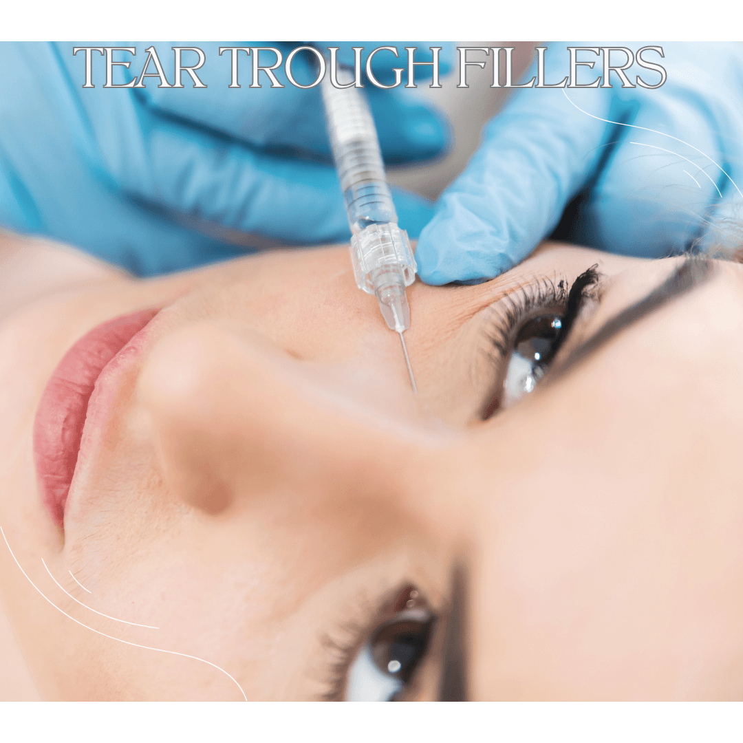 TEAR TROUGH FILLERS