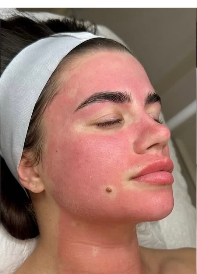 Facial Microneedling
