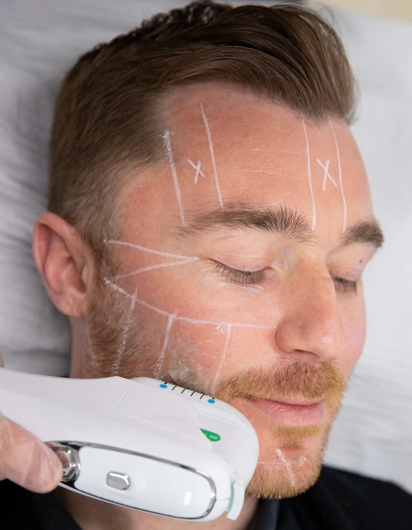 Experience the magic of a youthful, lifted appearance with our Non-Surgical Skin Lifting treatment! HIFU (High-Intensity Focused Ultrasound) is the latest breakthrough in skin rejuvenation, delivering remarkable results in just one session.