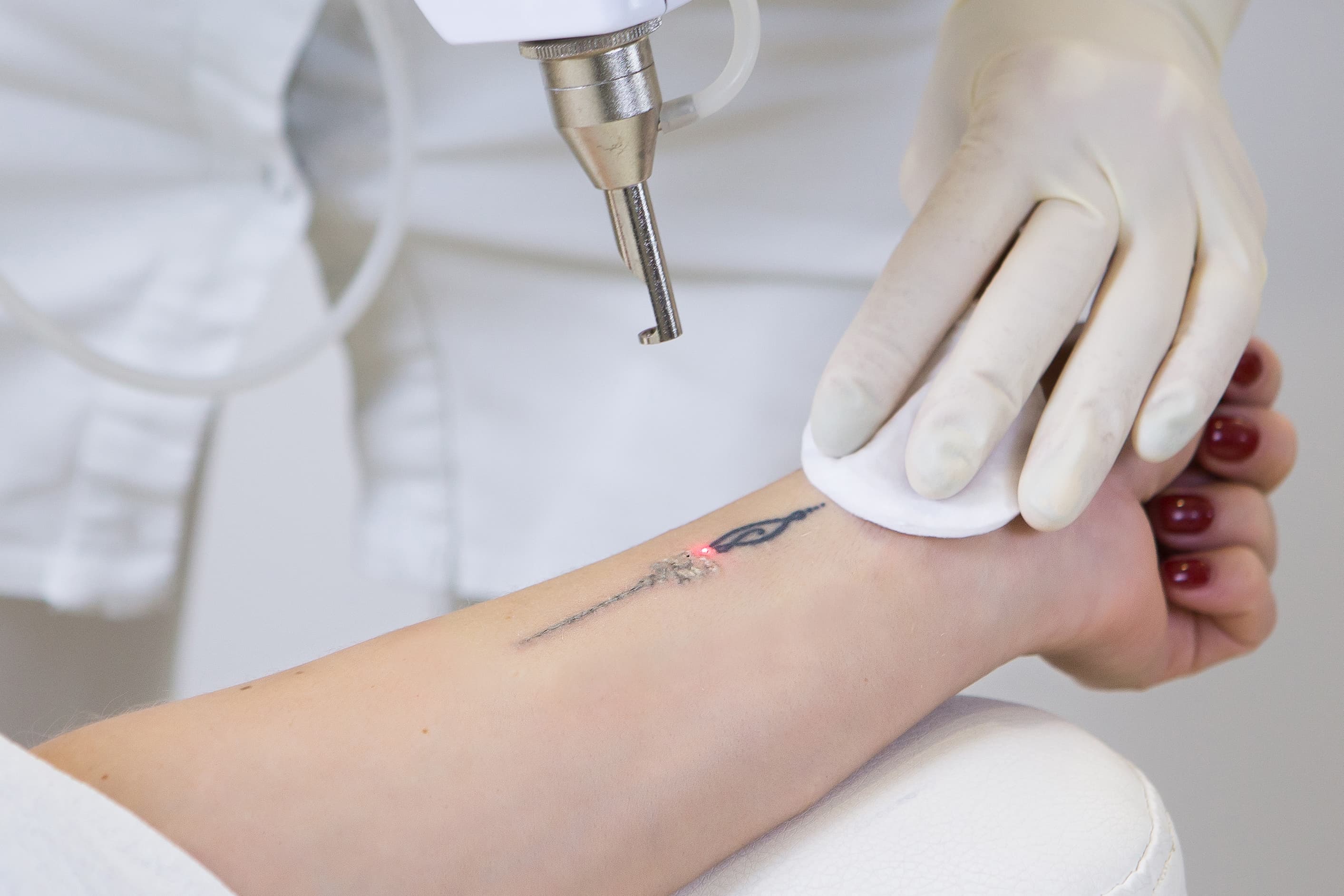Whether you’re looking to erase a past decision or lighten a tattoo for a cover-up, our expert team is here to guide you through the process with care and precision.