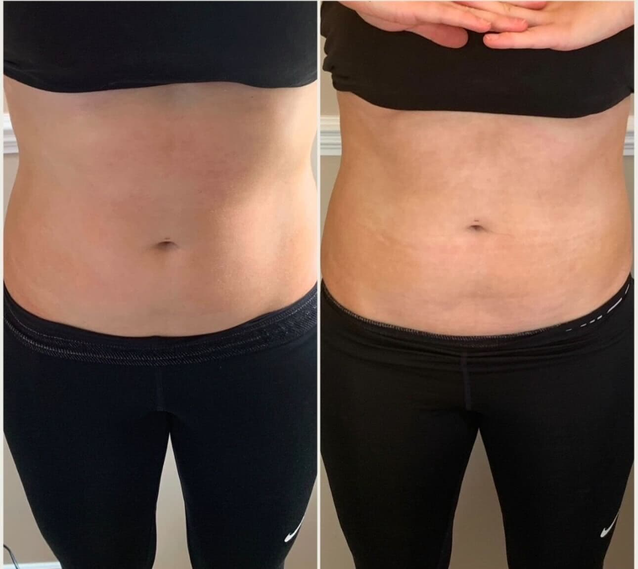 HIFU Body Contour 