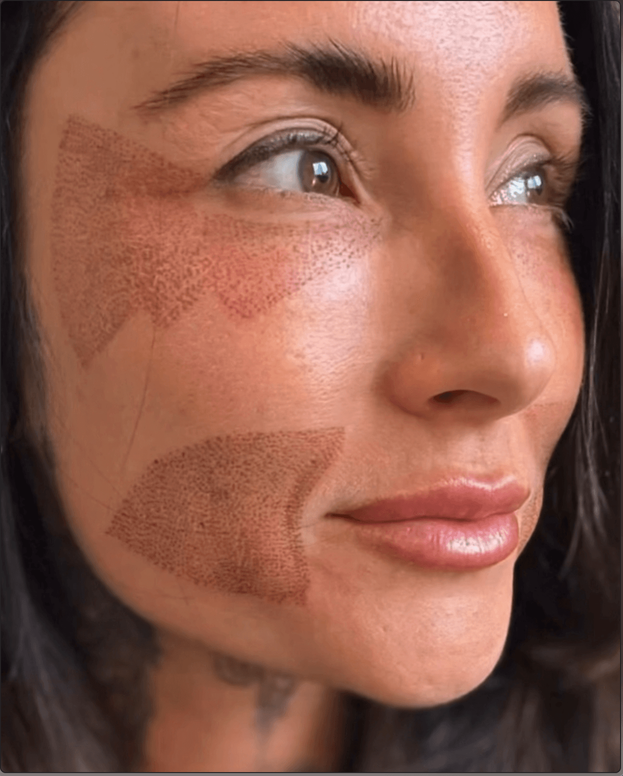 Plasma Fibroblast Plasma Fibroblast is an exciting, revolutionary treatment that offers incredible results without surgery! This non-invasive procedure works wonders by tightening and lifting your skin, effectively smoothing wrinkles, crow's feet, and under-eye bags. It’s especially popular for its powerful ability to reduce hooded eyelids and rejuvenate the delicate skin around your eyes. Call 0333 016 3500.