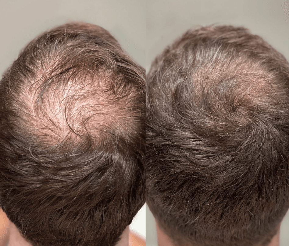 Hair Rejuvenation Prp A natural and highly effective hair restoration treatment designed to combat hair loss, stimulate dormant hair follicles, and promote healthy, thicker hair growth. Ideal for those seeking to enhance hair density and improve scalp health naturally. Book today at 03330163500.