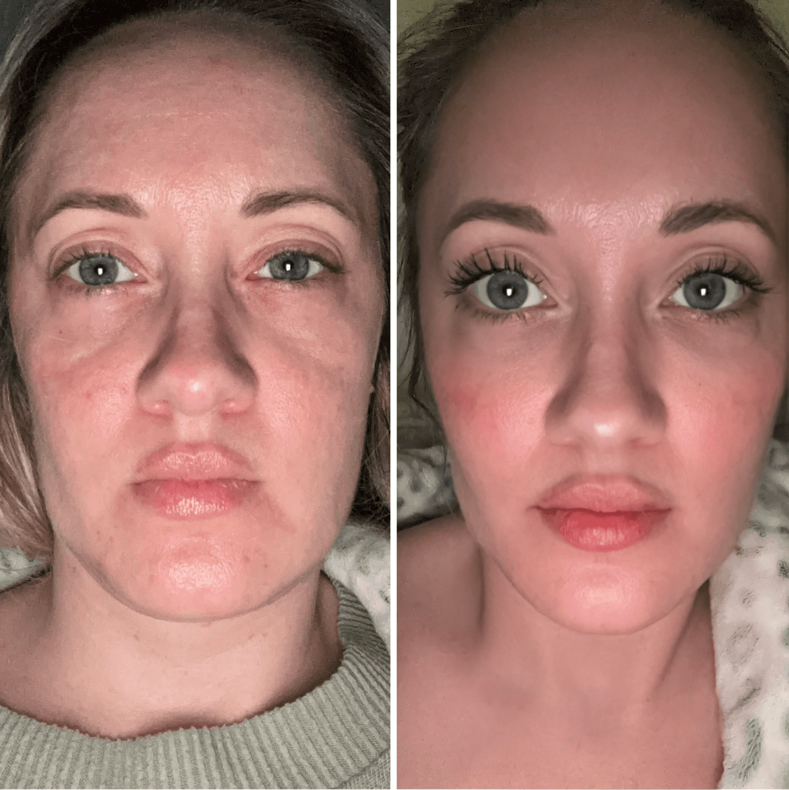 Achieve a more defined, balanced profile with our Dermal Filler Chin Sculpting.