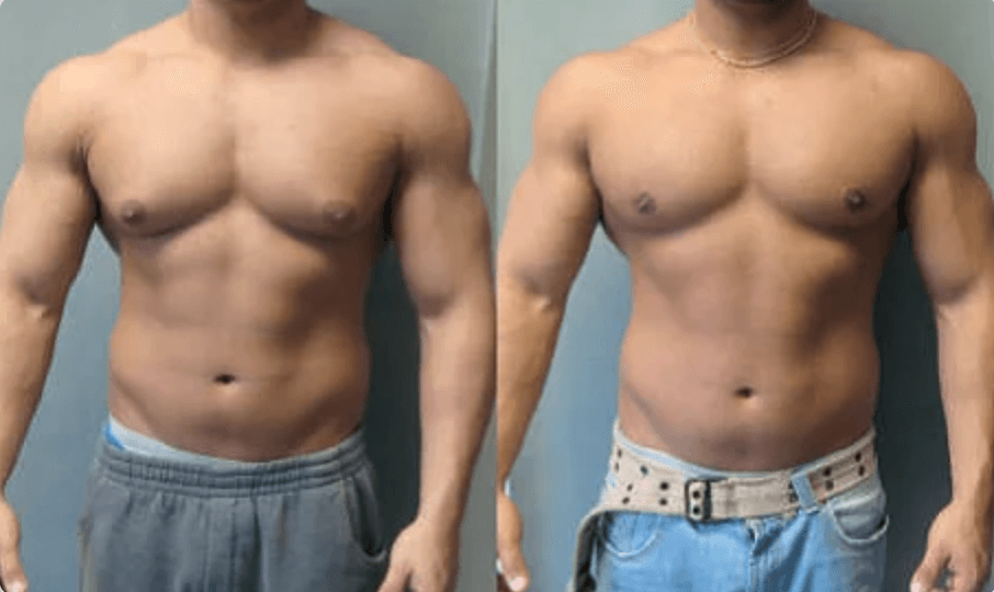3d Man Boobs The 3D-‘Man Boobs’ treatment is an entirely non-invasive fat reduction treatment with only two treatment sessions required. Call 0333 016 3500.