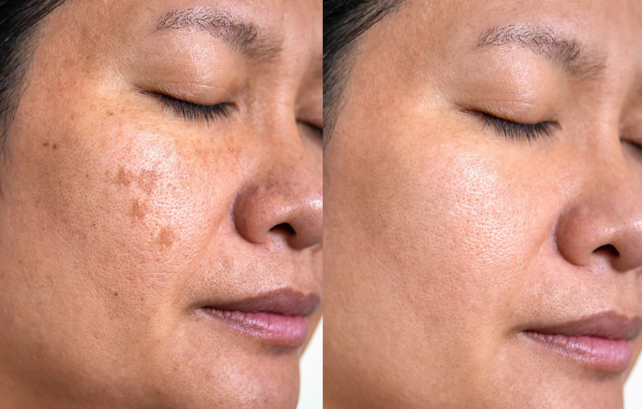 Pico Laser Hyperpigmentation Removal  The Pico Laser Pigment + Scar Removal treatment is an advanced laser technology designed to precisely target and break down pigmentation, sunspots, age spots, and scars from acne or injury. Book today!