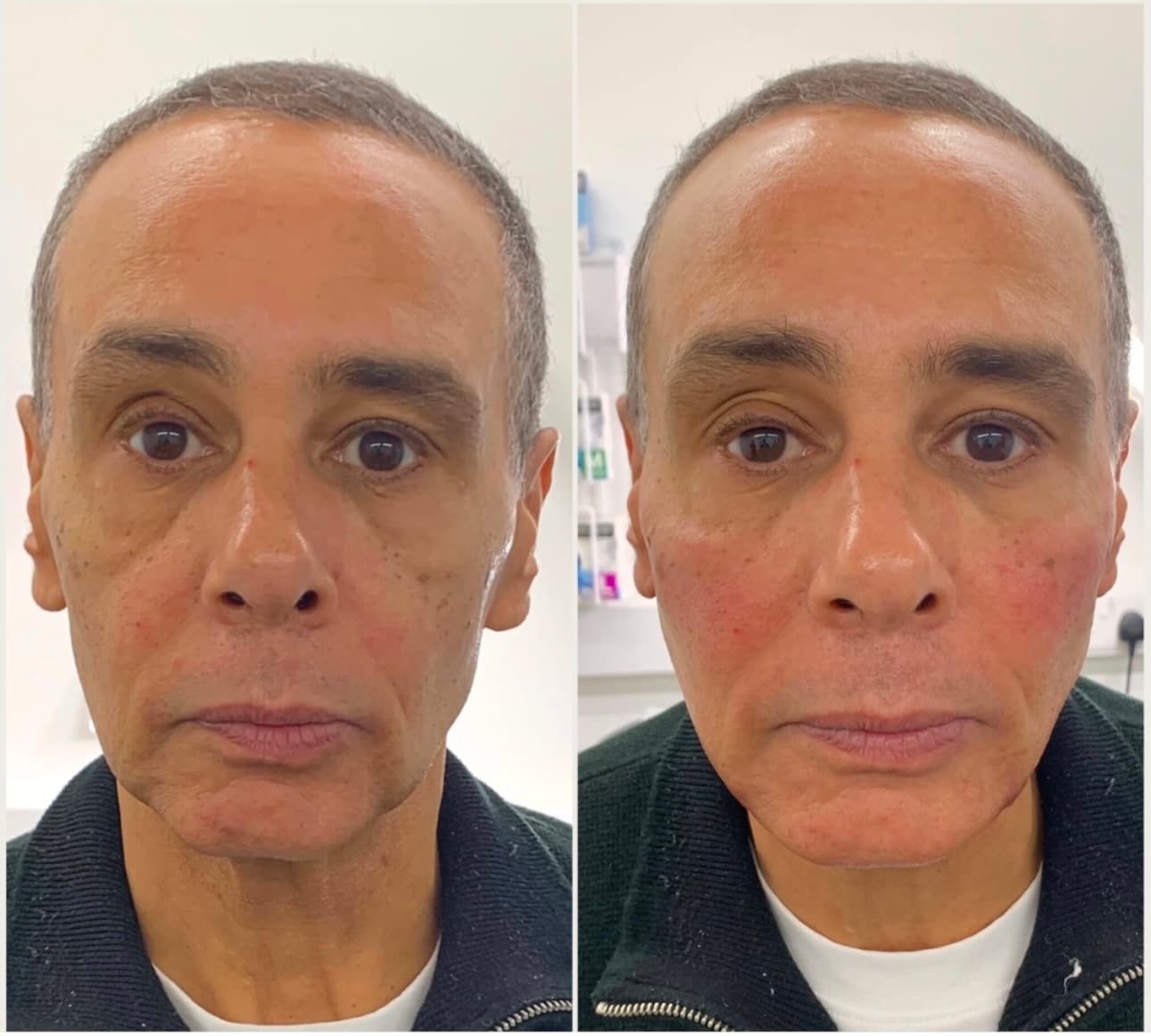 Our Mid Face Rejuvenation package is designed to target key areas where volume loss and deep lines create signs of ageing. This treatment expertly refreshes the central face for a lifted, smoother, and more youthful appearance.