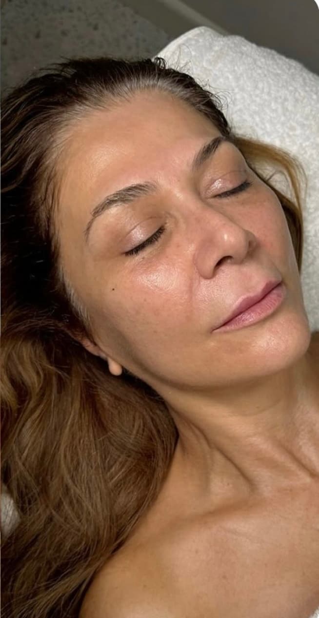 Radio Frequency Facial