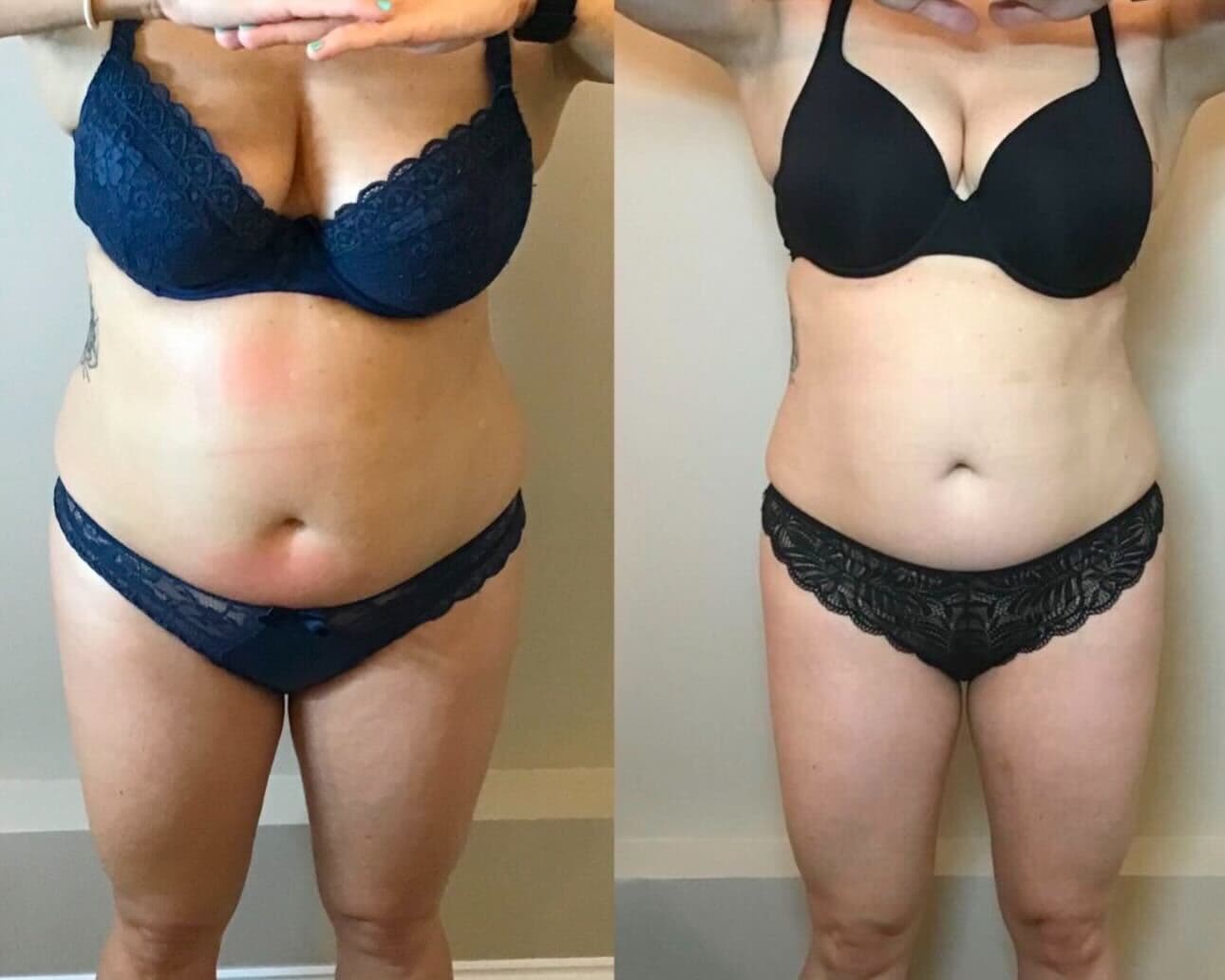 Ultimate Pro Fat Reduction