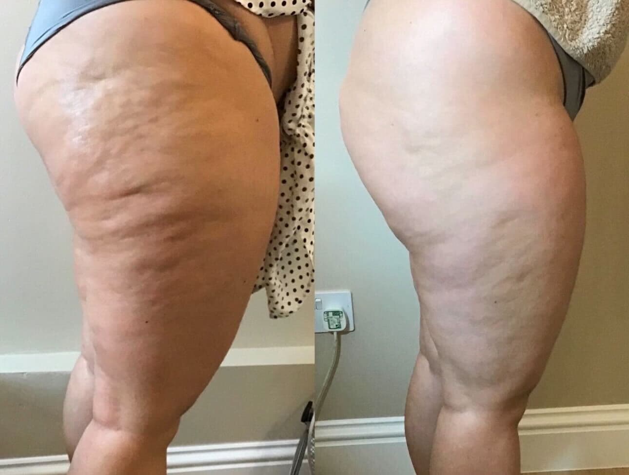 Skin Tightening & Cellulite Reduction