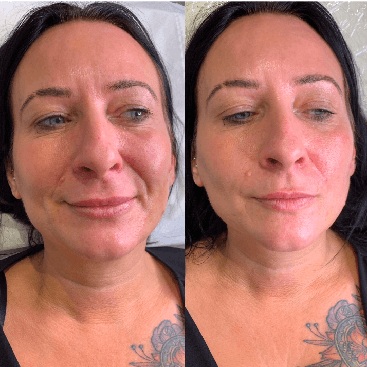 Nasolabials (Smile Lines)