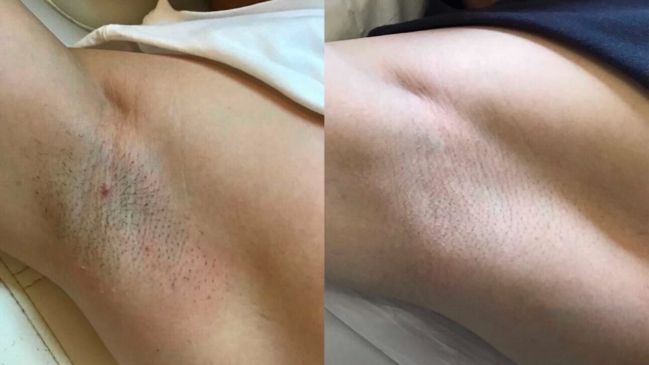 Laser Hair Removal