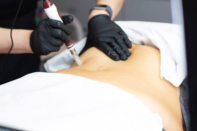 Body Microneedling