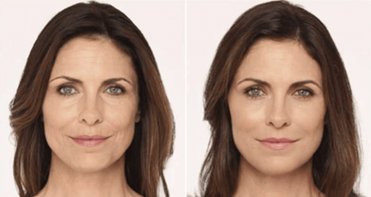 Radiesse Dermal Filler