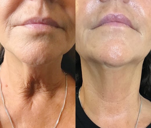 HiFu Results at Cosmetic Clinic